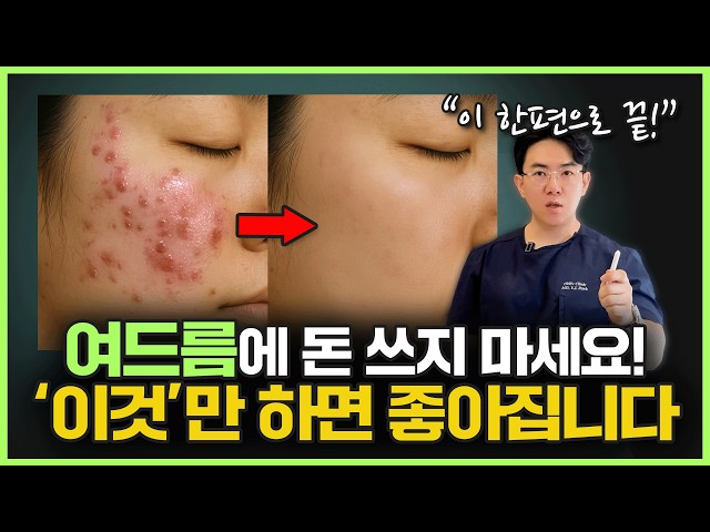 여드름, 왜 자꾸 나는 걸까? 전문가가 알려주는 진짜 이유와 관리법