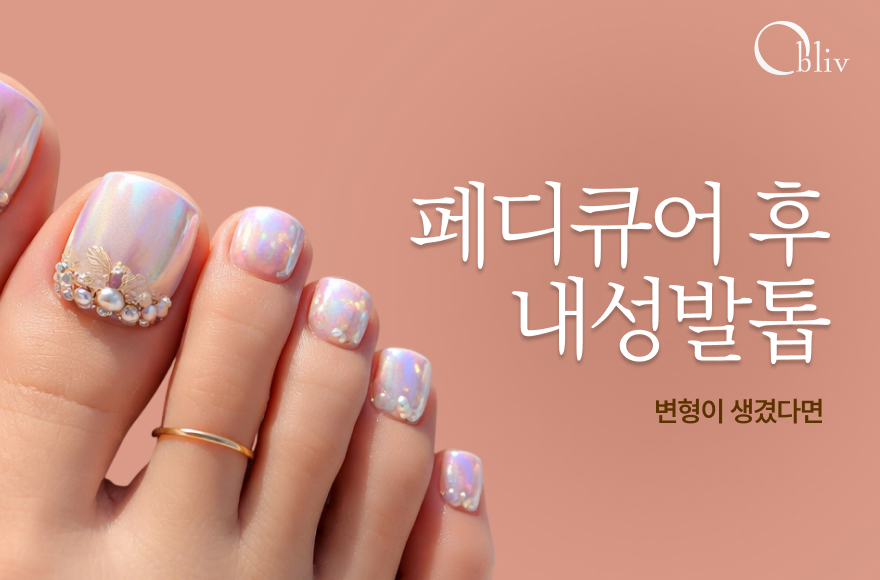 페디큐어 후 내성발톱으로 발톱 변형이 생겼다면_인천내성발톱병원