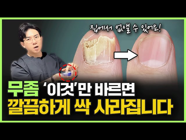 발바닥 무좀, 방치하면 감염까지? 원인부터 홈케어, 전문 치료까지 꼭 알아야 할 정보