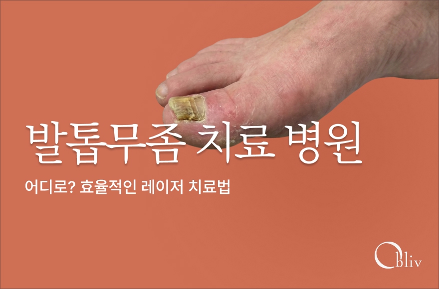 발톱무좀 치료 병원 어디로? 가열성vs비가열성 레이저 치료 비교 가이드 | 오블리브의원
