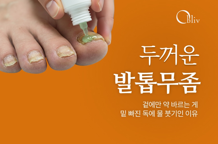 두꺼워진 발톱, 겉에만 '약' 바르는 건 '밑 빠진 독에 물 붓기'인 이유_인천발톱무좀