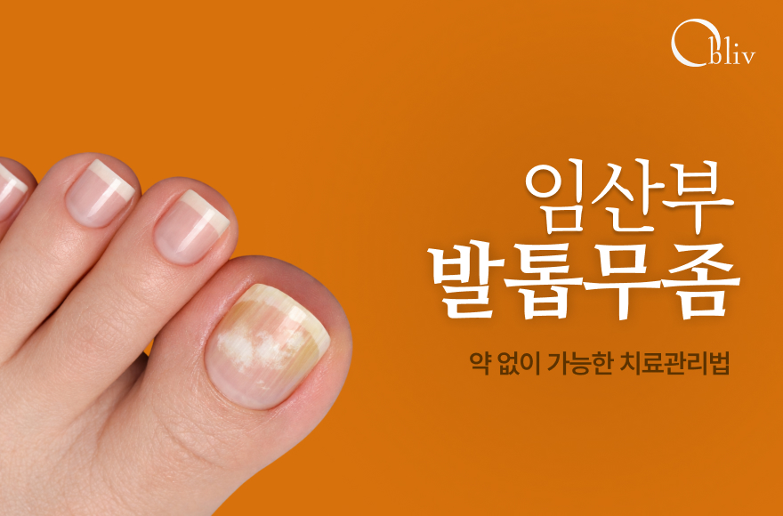 임산부 발톱무좀, 약 없이 가능한 치료관리법