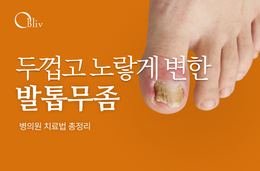 엄지발톱무좀, 두껍고 노랗게 변했다면? 발톱무좀병원 치료법 3가지 총정리