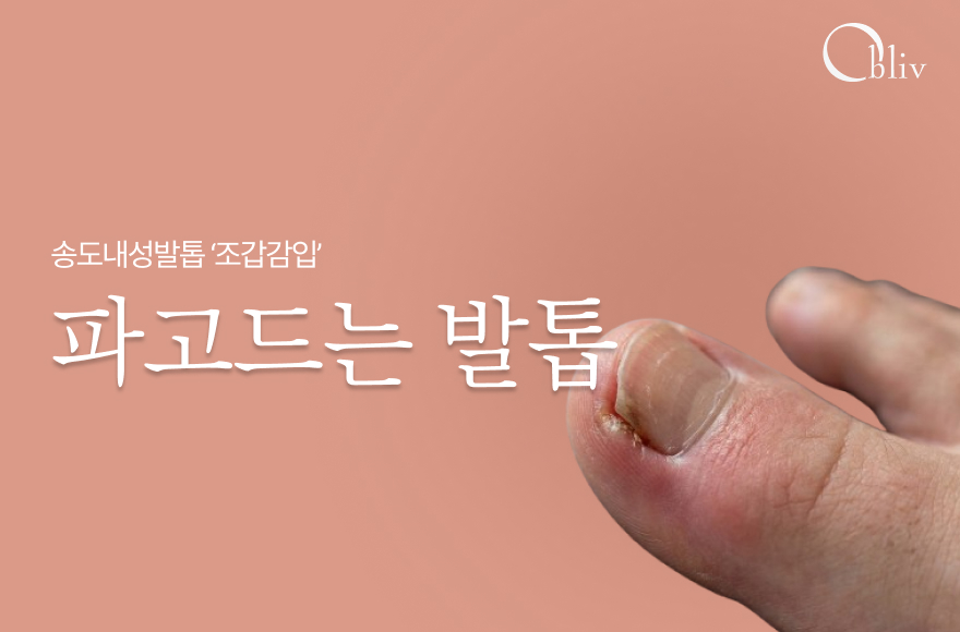 [송도 내성발톱] 파고드는 발톱 '조갑감입', 원인부터 맞춤형 치료법까지 정리