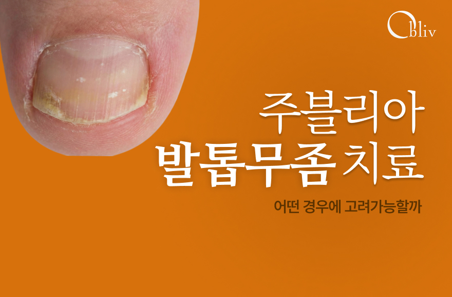 발톱무좀 치료 가이드: 주블리아는 어떤 경우에 고려되나
